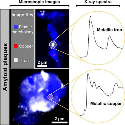 X-ray microscope images and X-ray absorption spectra obtained from two AD plaque cores, measured at Diamond Light Source beamline I08. X-images showed the plaques to contain both iron and copper deposits. X-ray absorption spectra from the highlighted regions were consistent with metallic elemental iron (top spectrum) and copper (bottom spectrum). Credit: Science Advances